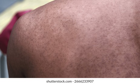 知っておきたい＞大人から赤ちゃんまで発症！あせも 汗疹 の原因・症状・予防法ロート製薬: 商品情報サイト