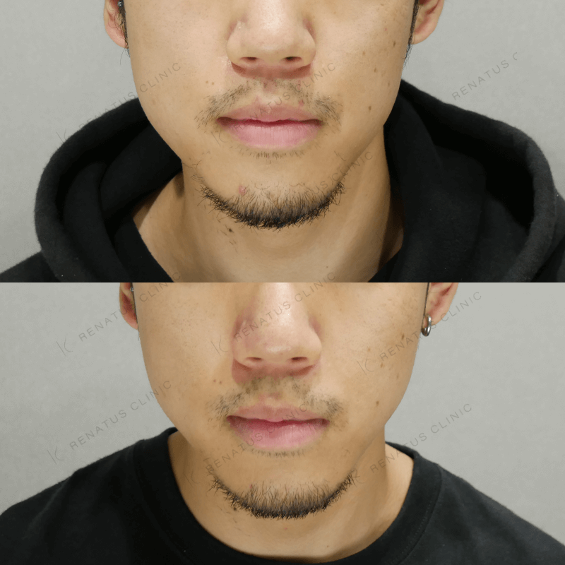 ヒゲ脱毛の効果は何回で出る？3回・5回の仕上がりを写真付きで解説＆おすすめクリニック＆サロンも紹介 - カスタムライフmedical