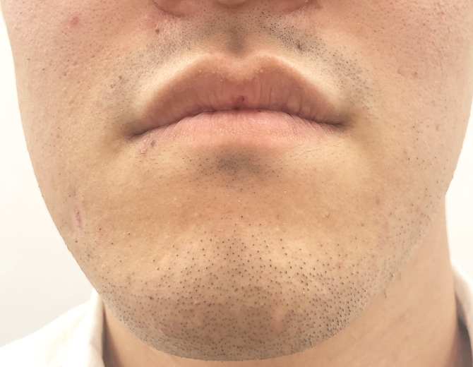 髭脱毛経過写真before＆after - 京都で髭脱毛ならメンズ脱毛サロンMen's SOLEIL