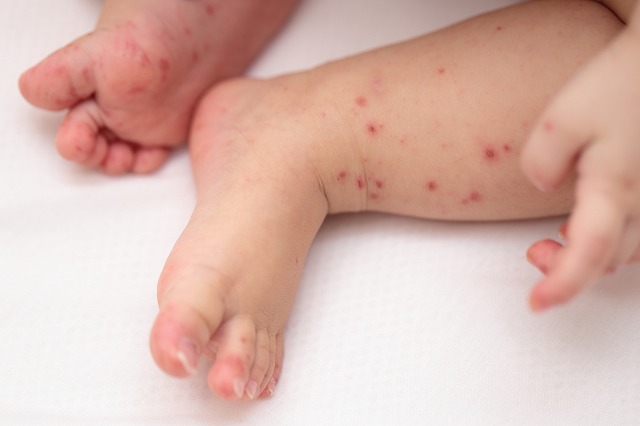 全国的に感染拡大の「手足口病」 記者が経験した１歳３か月の娘の看護 症状が改善するまでの経過は新潟2024年7月25日掲載 TeNYNEWS NNN