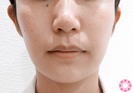 整形した感ゼロ！？ ビフォーアフター３人分ご紹介「小顔組み合わせ治療」 - WOMクリニック銀座