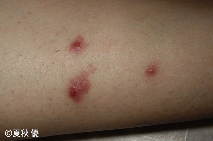 無視してはいけない虫刺され14選 症状別の画像で確認