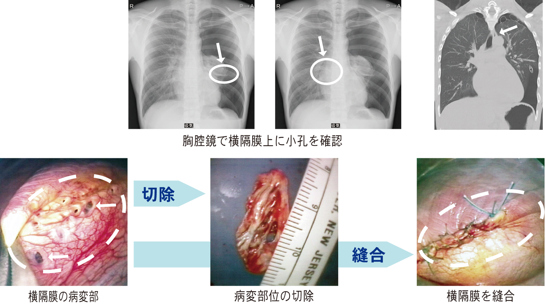 日々の症例 73 無気肺と閉塞性肺臓炎