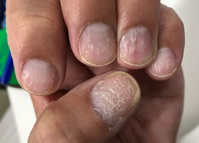 爪白癬と似た病気の説明スライド - 医療のイラスト・写真・動画、素材販売サイトのメディック medick