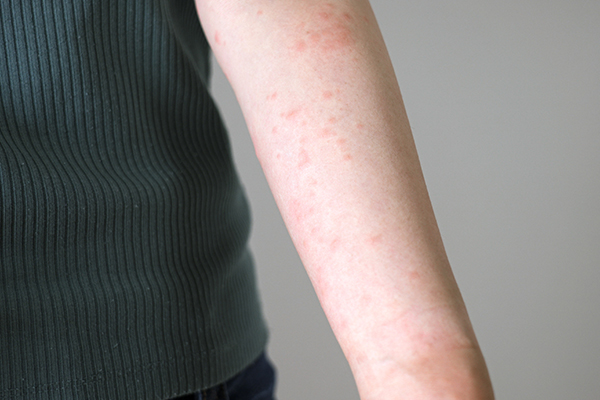 発疹・湿疹など症状写真あり ダニに刺された跡の特徴や症状・対策・あせもとの見分け方 - くらしのマーケットマガジン