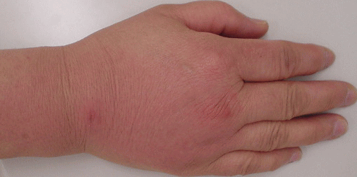 犬のかみ傷は。かみ傷の傷犬からの写真素材・画像素材 Image 65213629