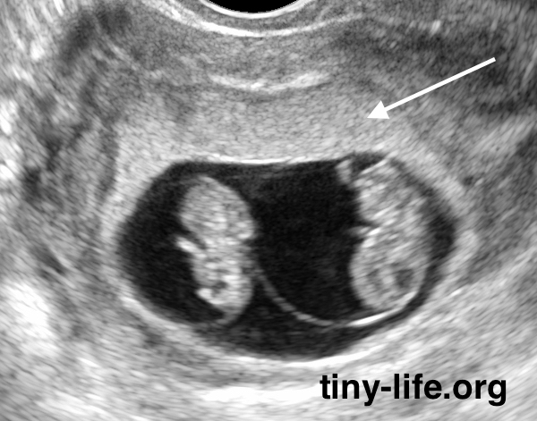 バセドウ病と異なる、つわりによる妊娠時一過性甲状腺機能亢進症 橋本病 長崎甲状腺クリニック 大阪
