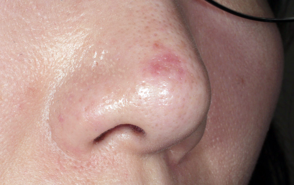 血管肉腫 皮膚腫瘍科がん研有明病院