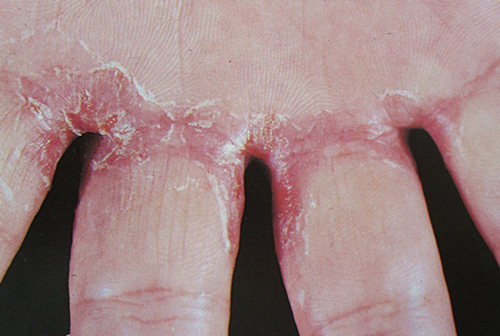 いんきんたむし - Wikipedia