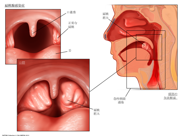 アデノイド増殖症耳鼻咽喉科の病気耳鼻咽喉科専門 医療法人財団 神尾記念病院
