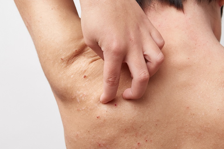 頭皮の帯状疱疹ヘアケアブログ:長崎、島原の美容室：Fletz フレッツ