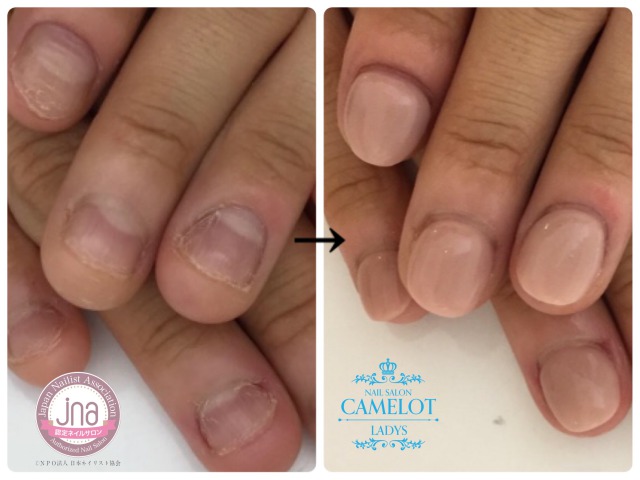 変形爪の再生 諦めない ネイルメディックス宇都宮巻き爪補正院