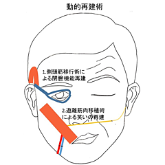 熱中症だと思ったら 初期症状そっくり『脳梗塞』かも 夏の水分不足で血液ドロドロ 違和感あれば６時間以内に受診！ 早期発見のヒントは「ＦＡＳＴ」特集MBSニュース