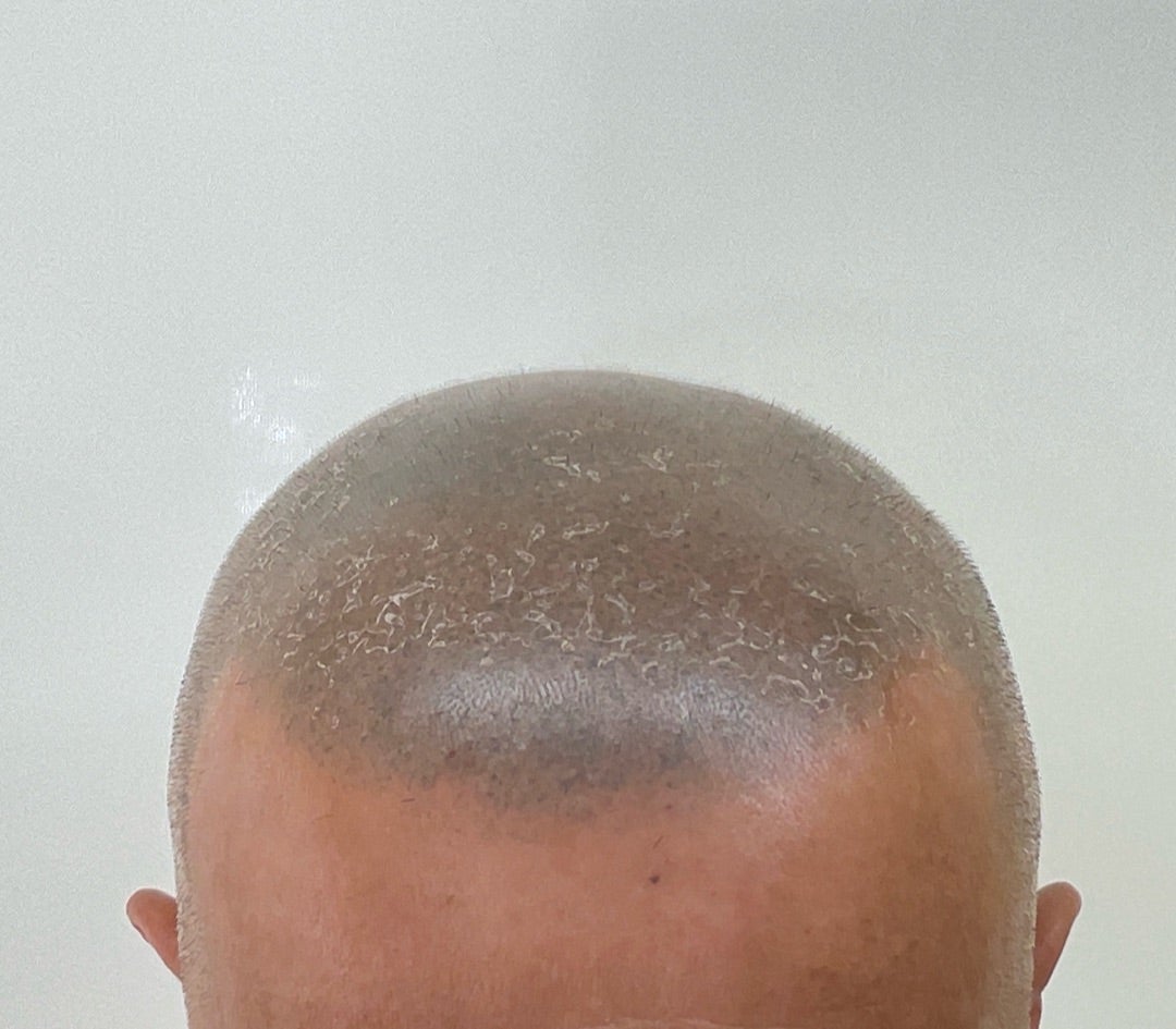 日焼け 皮むけの写真素材56687148- PIXTA