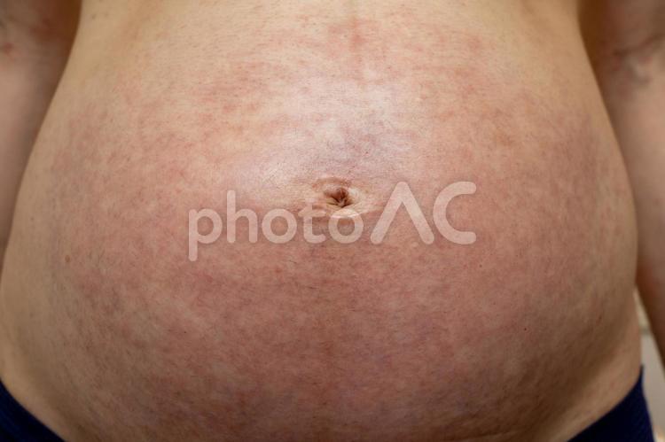 女性のお腹の皮膚にある皮膚病のとげのある熱発疹またはあせも。暑い日差しの中での屋外作業の原因となるヘルスケア肌は、汗をかきます。皮膚科医と治療薬の概念。の写真素材・画像素材Image 150226266