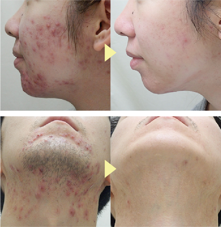 首ニキビの原因は？即効性ある治し方や治らない場合の対処