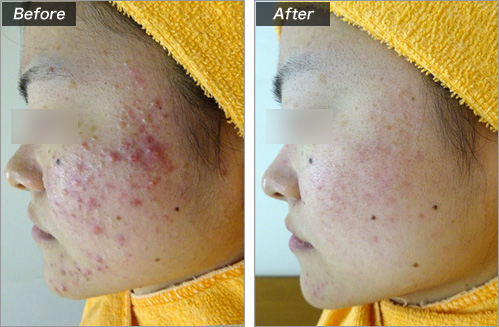 ニキビの赤みを1日で消す方法はある？ おすすめ美容施術を解説