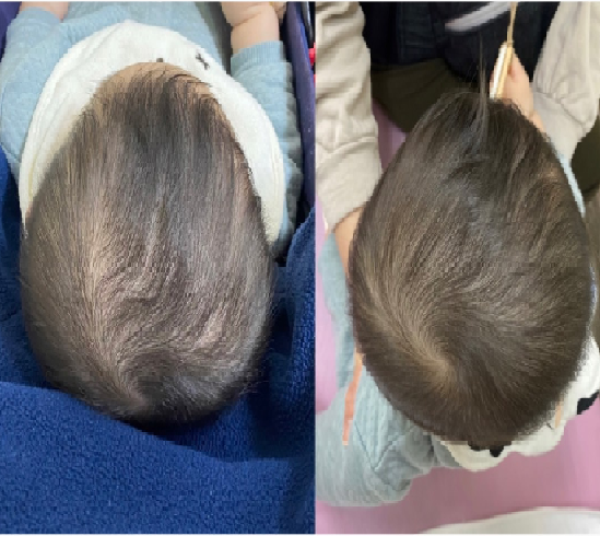 絶壁の事ばかり気にして過ごす毎日に疲れ出した頃、娘が通う信頼する小児科の先生に相談・スターバンド治療と出会う ヘルメット治療体験談短頭ヘルメット治療ならスターバンドのAHS Japan