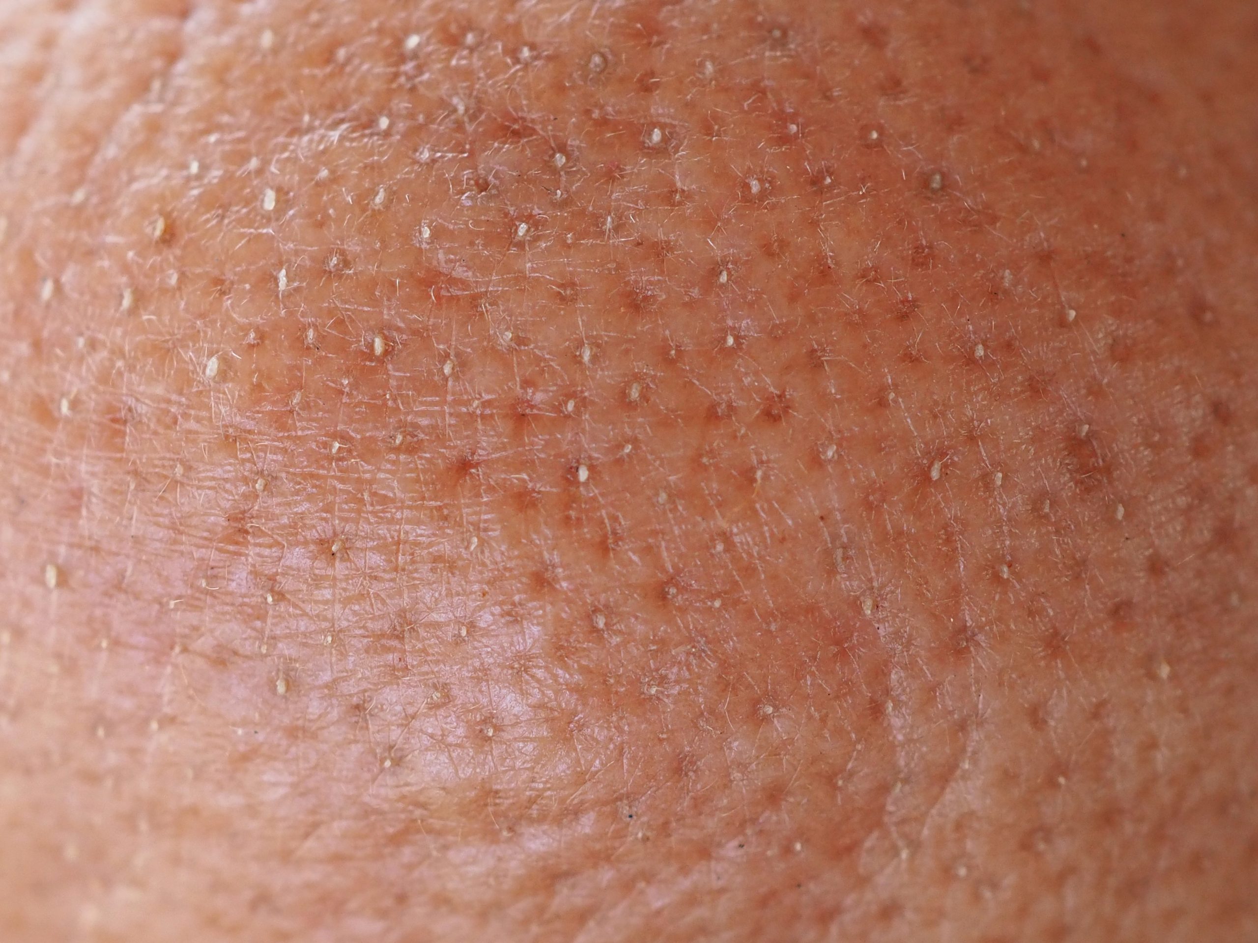 臭い！？白い塊！？ピアスホールのトラブルを防ぐ簡単にできる掃除方法│LUPIS ルピス 激安アクセサリー通販公式ブログ