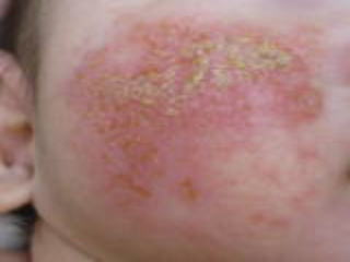 えぬくりブログ: 伝染性膿痂疹 とびひ