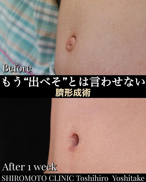 おへそ美人 骨盤でおへその形が変わる！開いた骨盤をしめる方法