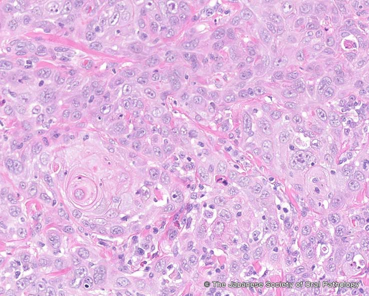 正常の膵臓の細胞が癌になる根本原因の一つを明らかに神戸大学ニュースサイト