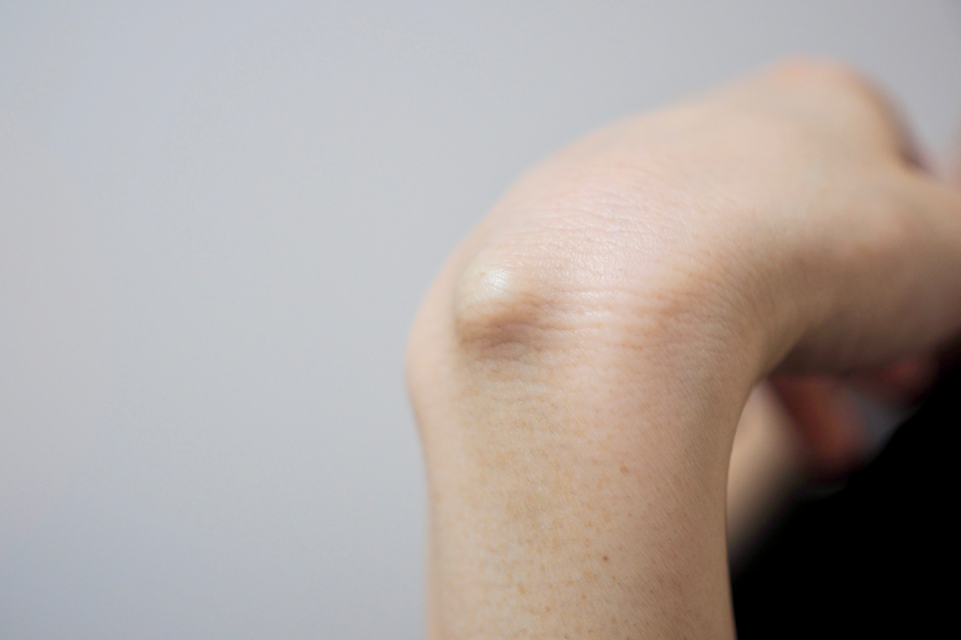 楽天市場 脇 毛穴 詰まり 白いの通販