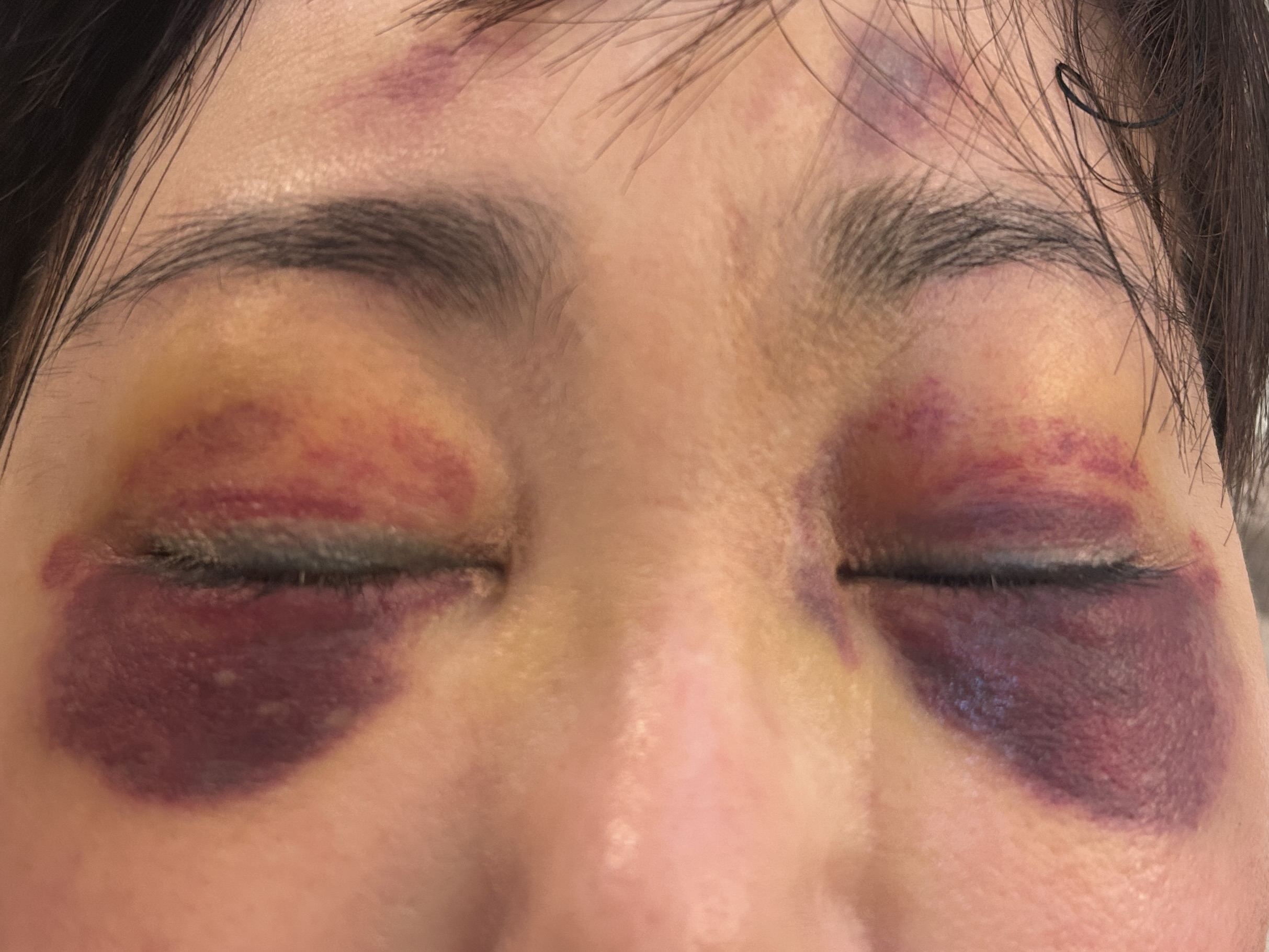 二重埋没法のダウンタイムの過ごし方は？早く治す方法やうまく隠せる言い訳・やってはいけないことなどを紹介新宿の美容外科・皮膚科ならハナビューティークリニック