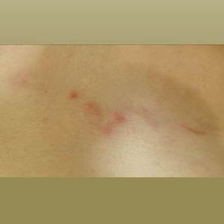 蕁麻疹クリニックひいらぎ皮膚科形成外科池尻大橋・渋谷・三軒茶屋