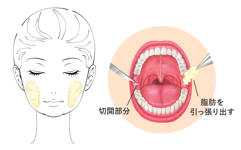 頬の顔痩せ 頬の内側の肉を落とす方法！ - YouTube