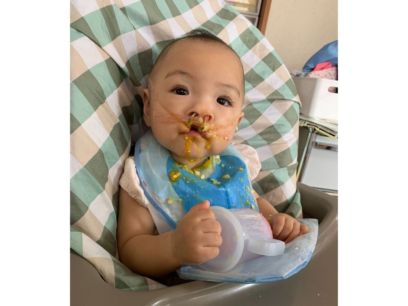 口唇口蓋裂の治療ってどんなことをするの？ 妊娠～産後ベビーカレンダー