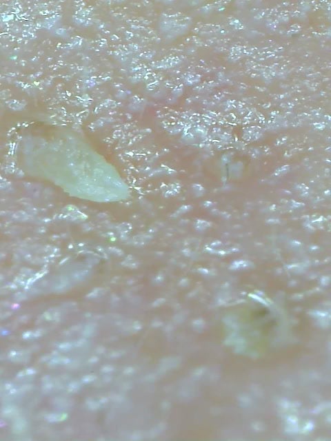 老廃物、角栓 など毛穴詰まりを大掃除！ プロの 毛穴ケア 徹底レポ ビューティニュース 美容メディアVOCE ヴォーチェ