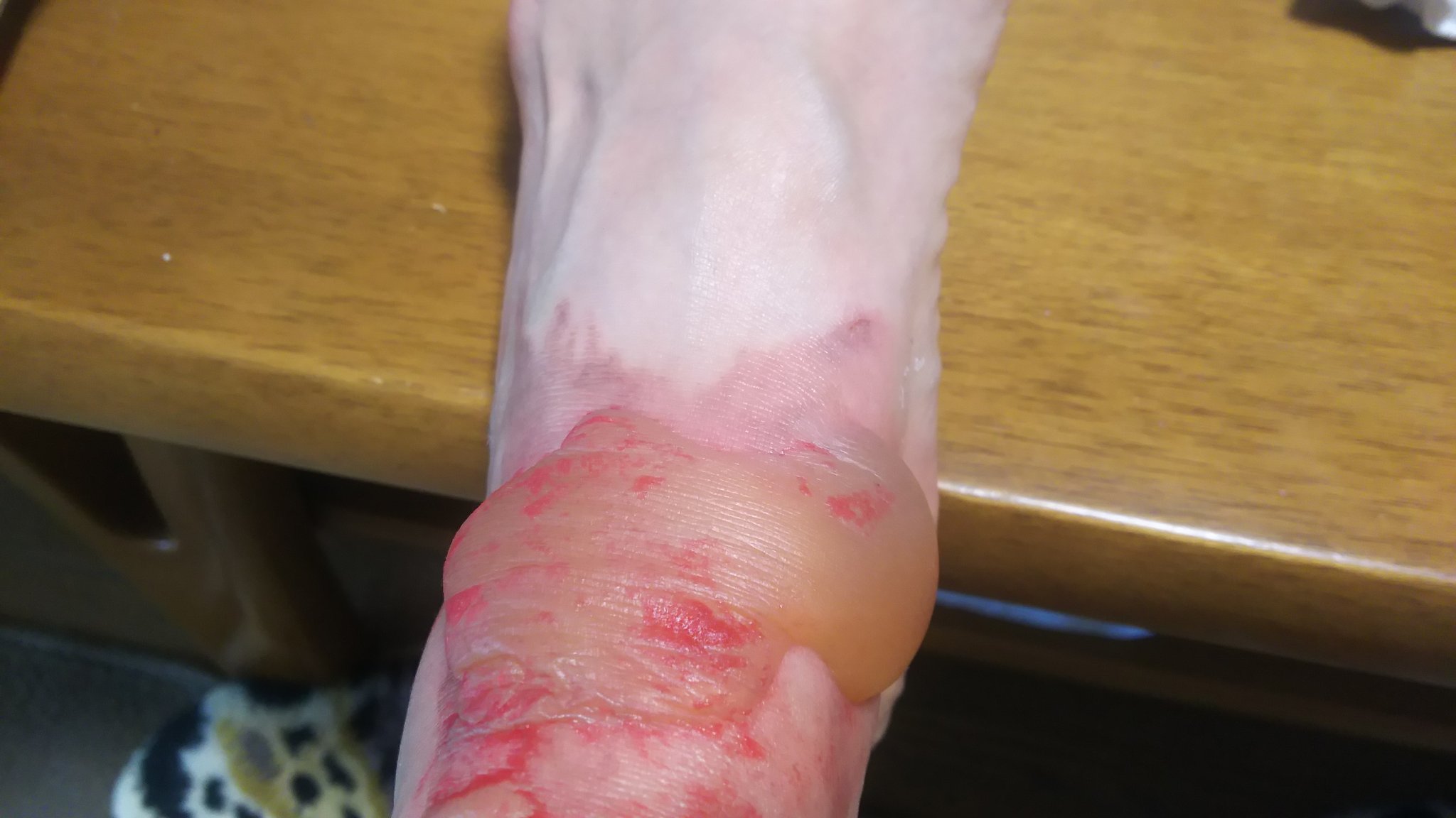 皮膚悪性腫瘍三木市の皮膚科・美容皮膚科 さかい皮フ科クリニック