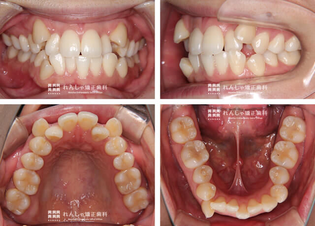 ガタガタ・出っ歯・受け口の歯列矯正の治療例静岡市のエンゼル矯正歯科