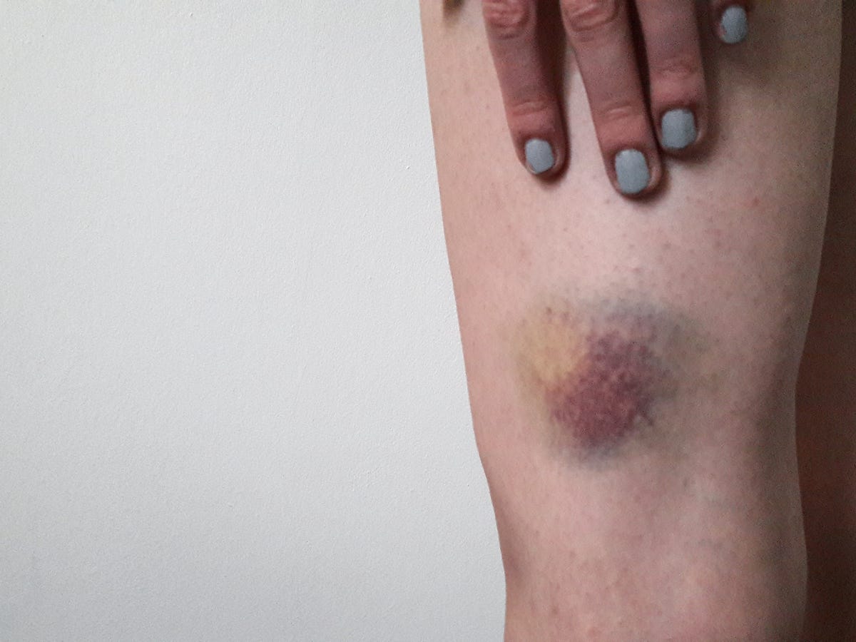 質問です。 - 腕や足などに、黄色いあざ？が気づかないうちにできていて、- Yahoo!知恵袋