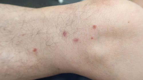 水疱性類天疱瘡ひらぐん皮ふ科・アレルギー科