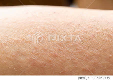 子どもの背中にあせもが！「放置で治る」「シャワーは逆効果」って噂は本当？ - 株式会社エバーセンス