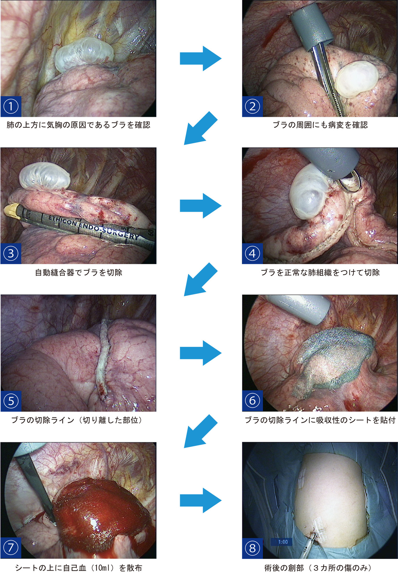 無気肺見て！わかる！病態生理と看護 花子のまとめノート