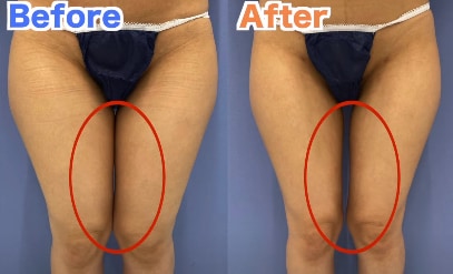太ももの脂肪吸引脂肪吸引専門のTHE CLINIC