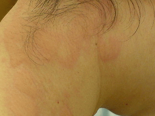 じんましん大森・大木皮膚科 蕁麻疹でお困りなら