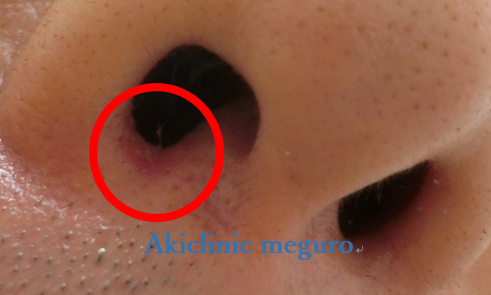 鼻にできたニキビ跡の炎症が皮膚がんに 「自分の顔を見るのが嫌だった」女性がSNSにあえて投稿する理由 米- 新羽駅前耳鼻咽喉科クリニック横浜市港北区の耳鼻科