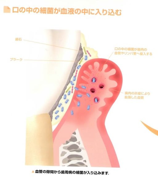 口腔内のカンジダ菌について - けんせい歯科
