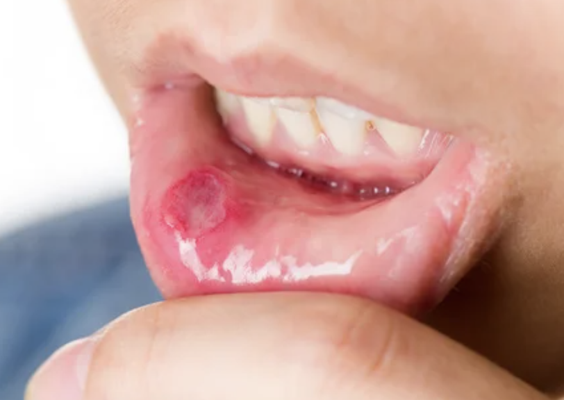 白い口内炎と赤い口内炎、それぞれの特徴とできる原因福山市の歯科相談室