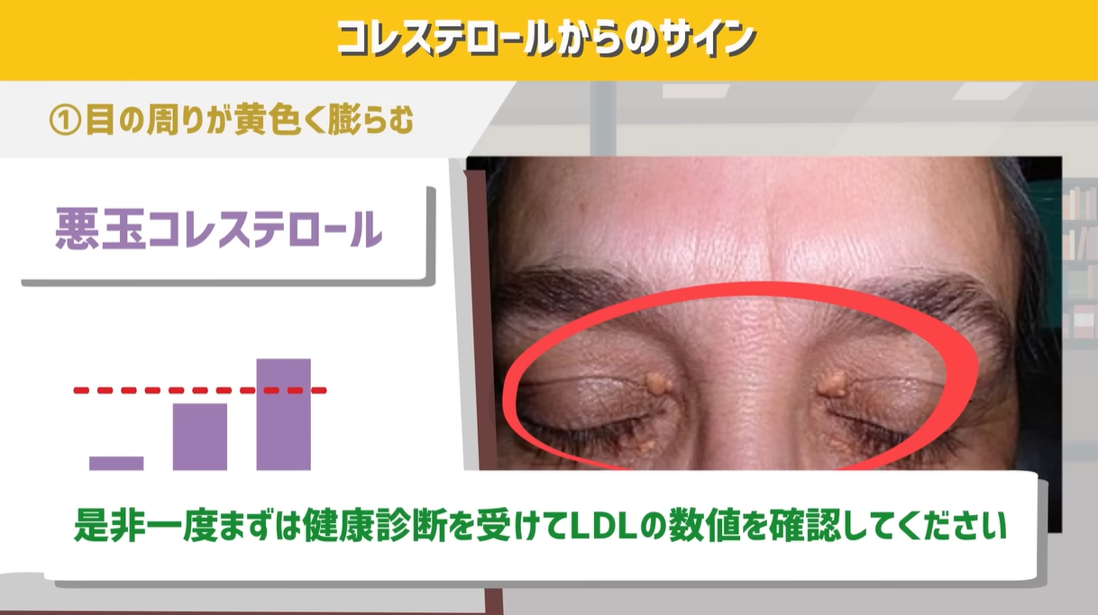 ドライアイ最大の原因は涙の油不足 脂質異常なら注意 - 日本経済新聞