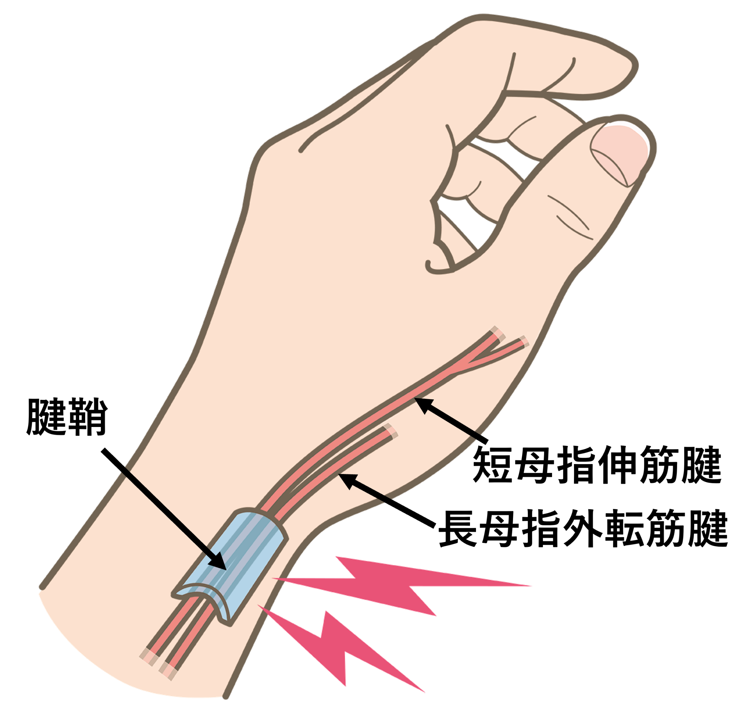 手をついたら手首が痛い！自分でできる治し方 悪化予防方法こばやし接骨整骨院グループ