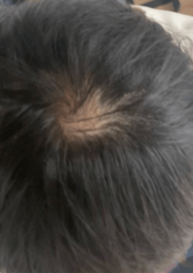 高校生男子つむじ周りの抜毛症 初回〜4回 ほぼ抜毛している事が、分からなくなりました。抜毛症抜毛症改善プログラム抜毛抜毛癖