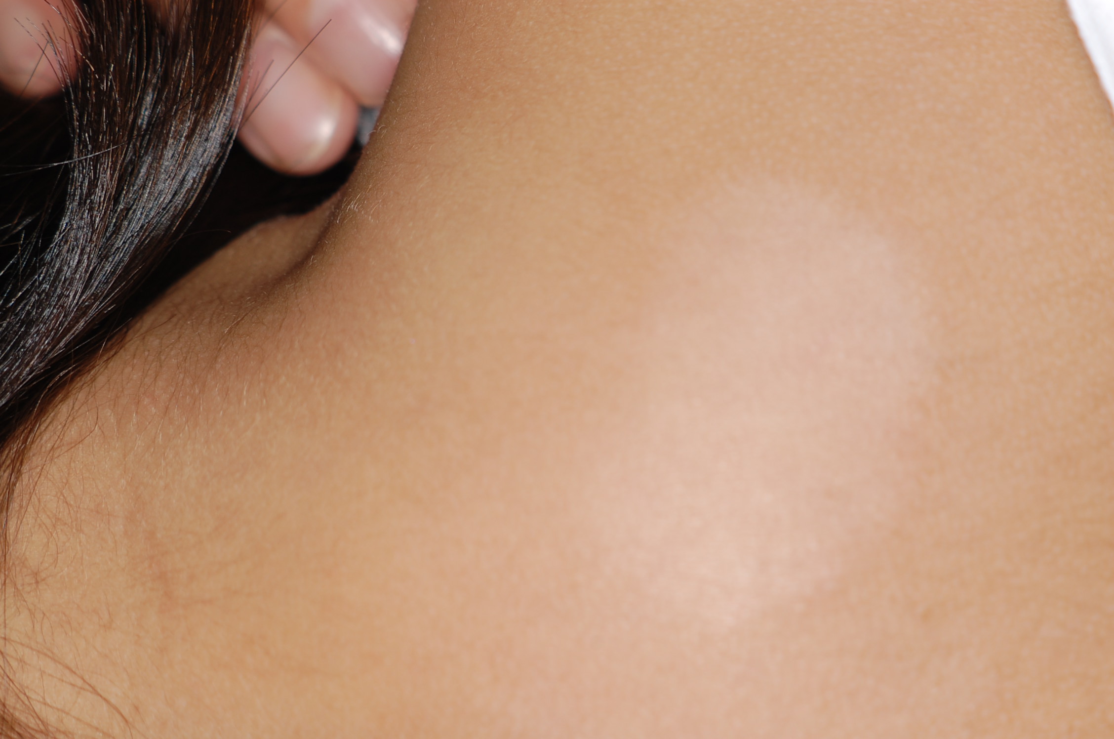 👧👦 夏に相談が多い 単純性粃糠疹 ひこうしん ・俗名はたけ 幼児や小学生の、主に顔に 出現する境界があまりはっきりとしない脱色素斑 白抜け のことです。 夏に日焼けをすると はたけの面は黒くなりにくいので 白さが目立ってきます。 通常、かゆみのない場合が