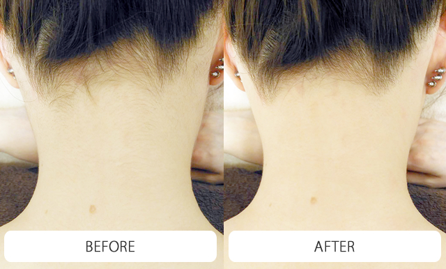 医師監修 繰り返すうなじニキビの徹底治療！原因から予防方法まで詳しく解説ハダメディア by BIHADADO.TOKYO