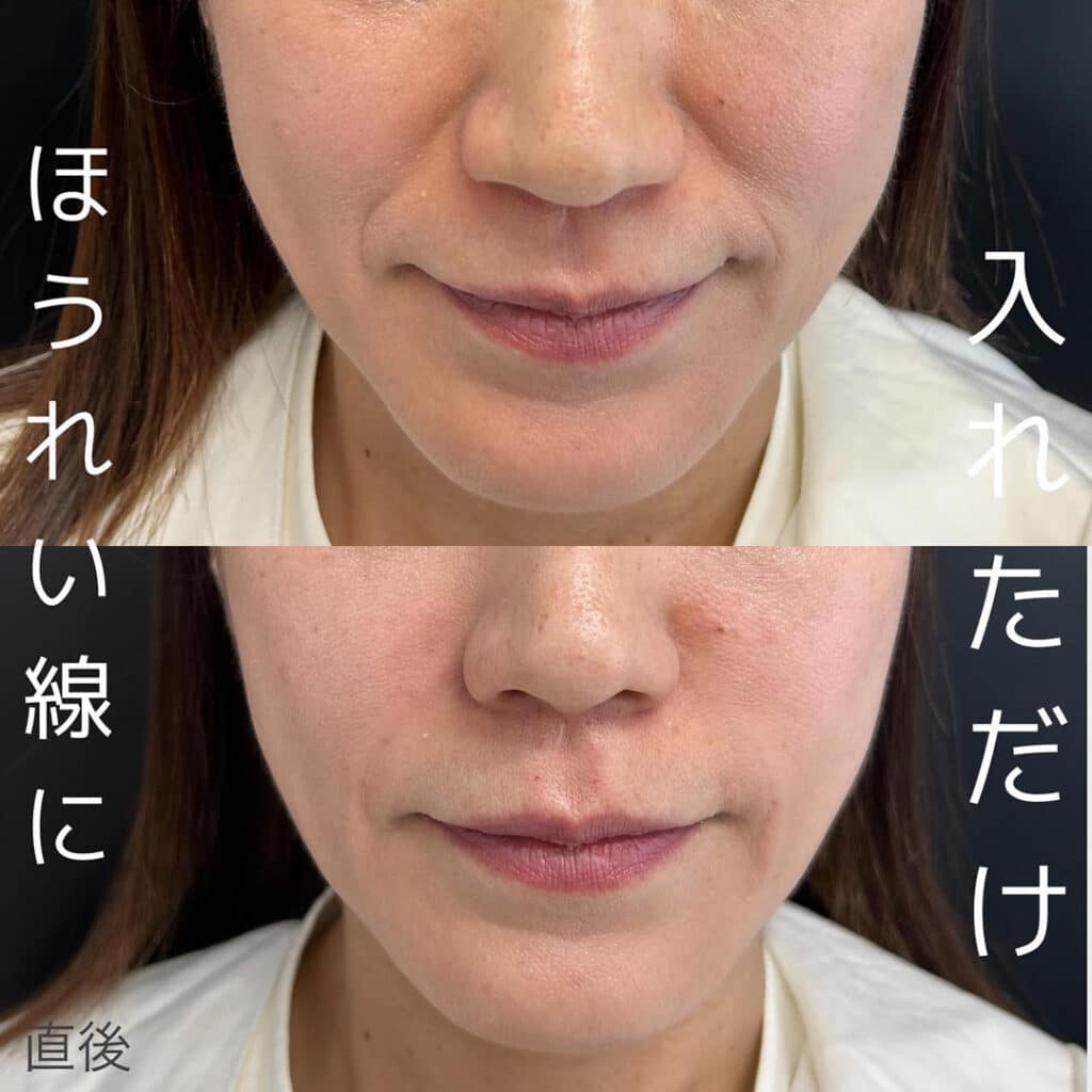 大阪 ほうれい線改善におすすめの美容皮膚科5選！効果的な治療法も紹介大阪 心斎橋、梅田 の美容皮膚科・美容外科 Wクリニック