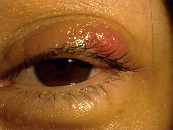 瞼にできたものもらいの写真・画像素材-Snapmart スナップマート